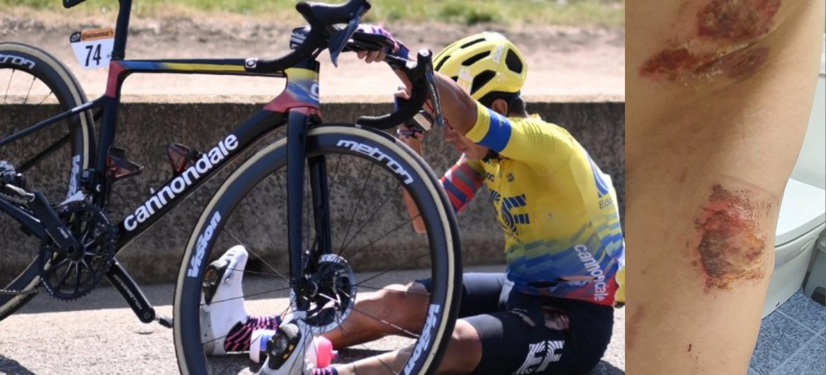 Las fuertes heridas que le dejó el Tour de Francia al antioqueño Sergio Andrés Higuita